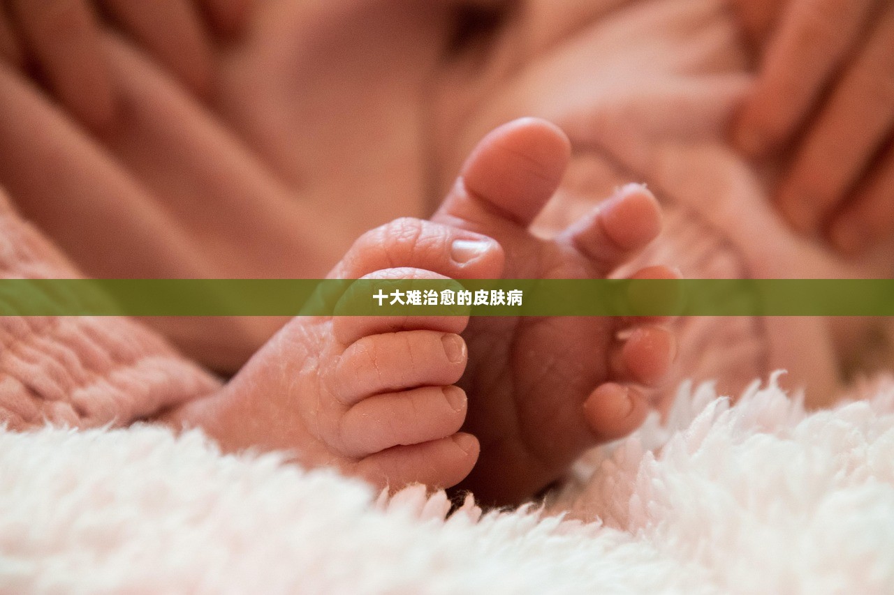 十大难治愈的皮肤病